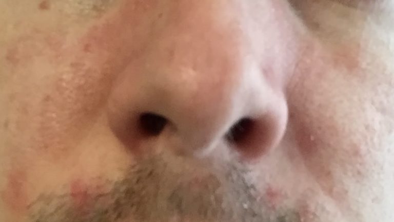 Demodex Milben beim Menschen im Gesicht, Haarbalgmilben Therapie