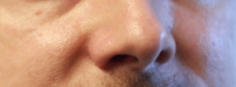 40++ Milben im gesicht bilder , Demodex Milben beim Menschen im Gesicht, Haarbalgmilben Therapie